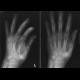 Fracture of navicular bone, rhizarthrosis: X-ray - Plain radiograph